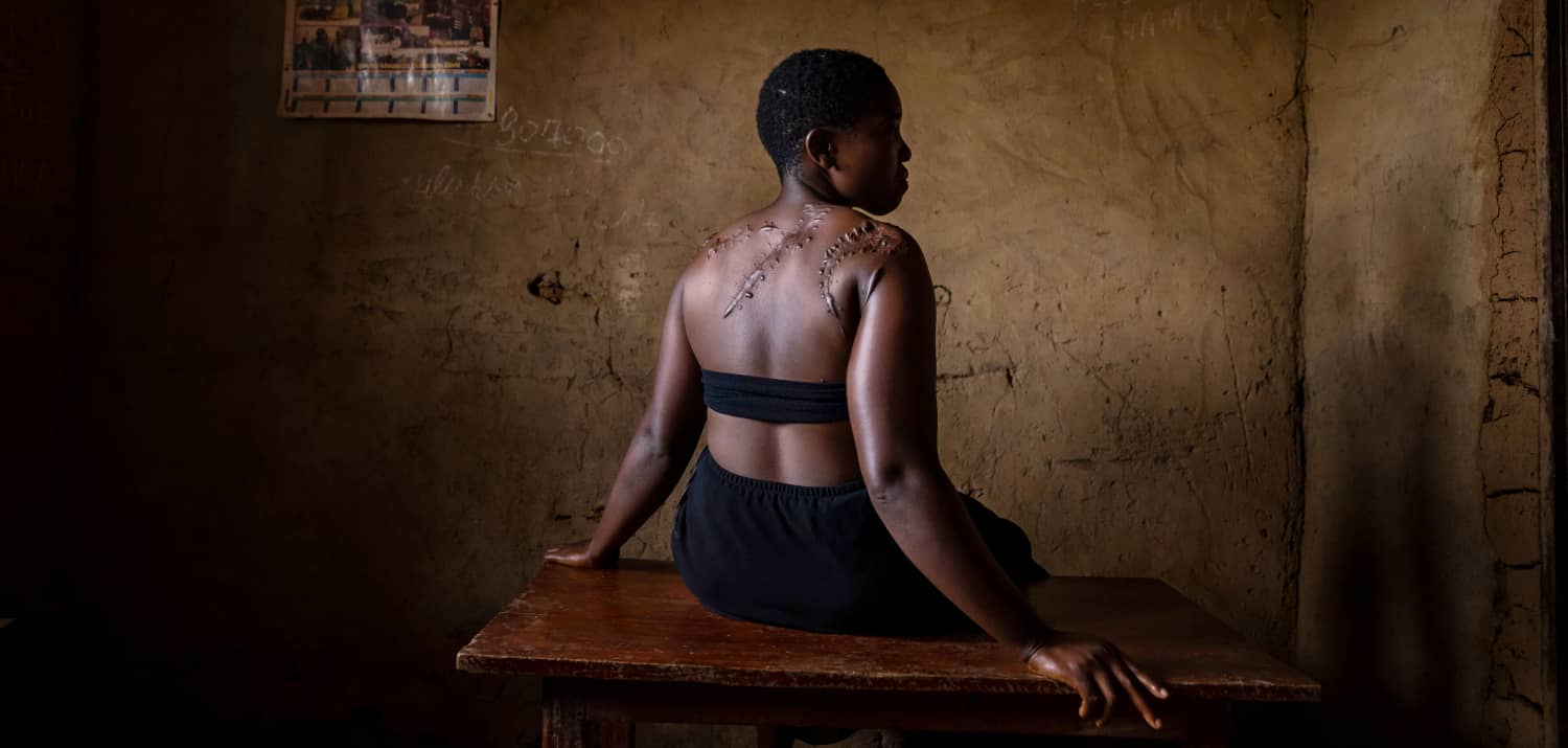Mujer sobreviviente de secuestro y violencia sexual en la República Democrática del Congo mostrando cicatrices de conflicto
